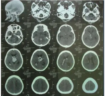 Gambar 1. CT-scan Kepala Nn. D 
