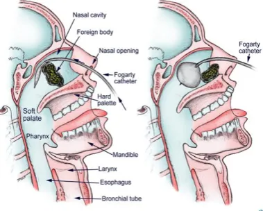 Gambar 2. Pengunaan Forgarty Catheter7