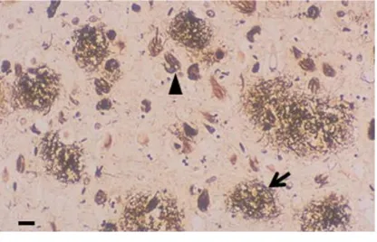 Gambar 1. Gambaran Mikroskopis pada Potongan  Otak Pasien AD. Terlihat adanya Plak Aβ (panah) dan Neurofibrillary Tangles (kepala panah)12 