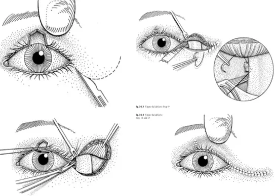 Gambar 3.3 Teknik Semicircular Flap 
