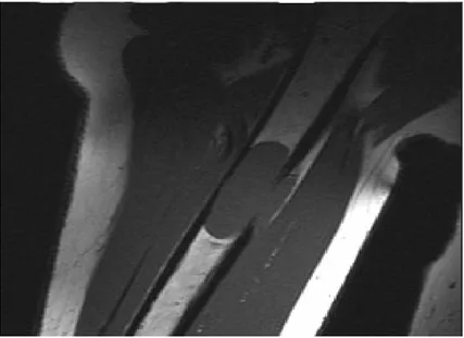 Gambar 13. Foto potongan koronal T1 weighted-MRI  pada suatu lesi myeloma di humerus. Gambaran ini menunjukkan lesi dengan intensitas rendah