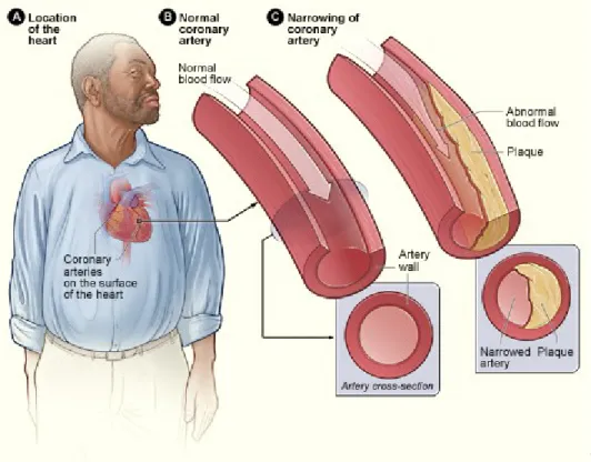 Gambar 2: Perbedaan arteri normal dan arterosklerosis 2.1.5 Pengobatan 