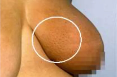 Gambar 1.3 Kelainan kulit seperti kulit jeruk pada korpus mammae  yang merupakan tanda kanker payudara 