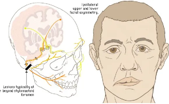 Gambar 2. Wajah Bell's Palsy.