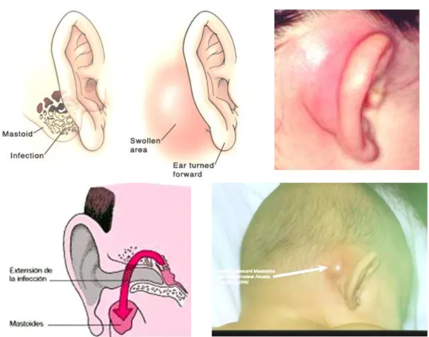 Gambar 6. Mastoiditis 