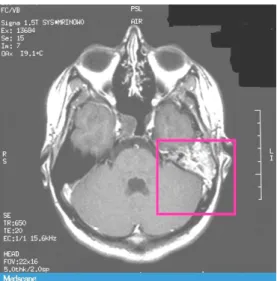 Gambar 7.  Mastoiditis  Gambar 8. CT scan mastoiditis 