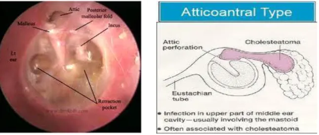 Gambar 11. Perforasi attic 