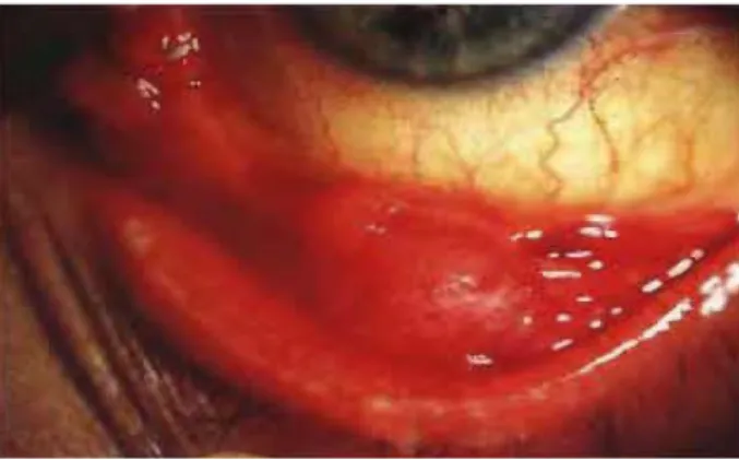 Gambar 9 Granuloma konjungtiva disertai dengan folikel pada sindroma okuloglandular Parinaud.