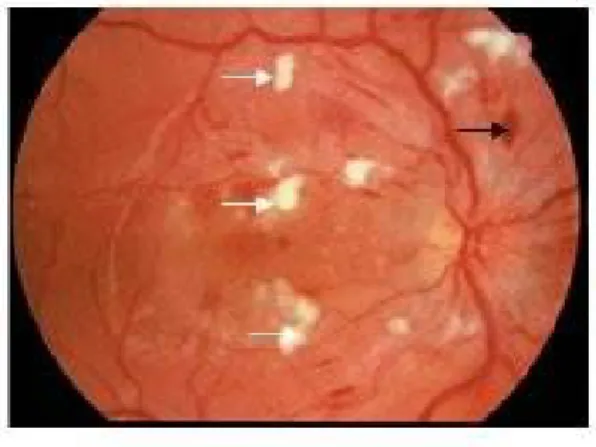 Gambar 4. Moderate Hypertensive Retinopathy. AV nicking (panah putih) dan cotton wool spot (panah hitam) (A)