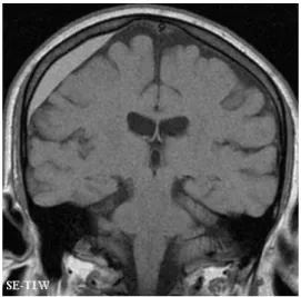 Gambar . MRI pada SDH  (unipa.it) 