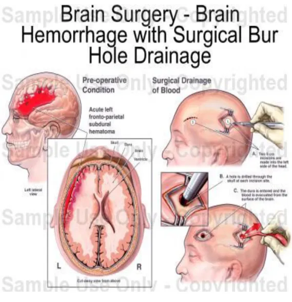 Gambar . Burr Hole                   (catalog.nucleusinc.org) 