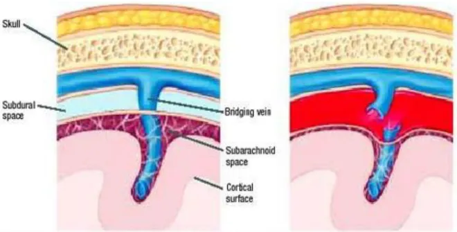Gambar :Subdural hematoma 