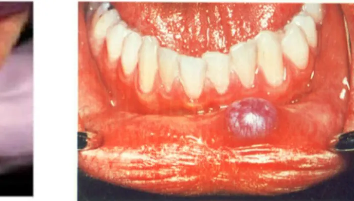 Gambar 3 : Mucocele