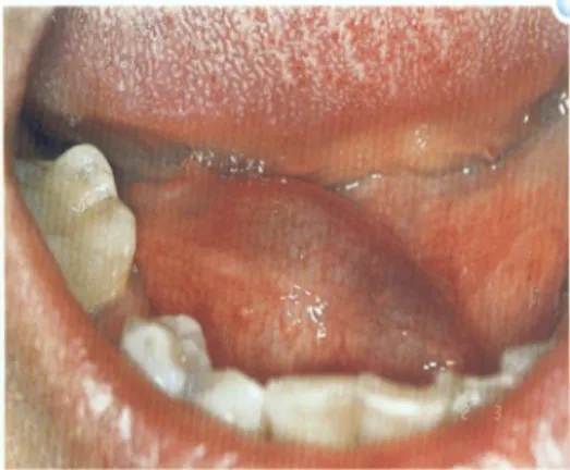 Gambar 5 : Sialadenitis