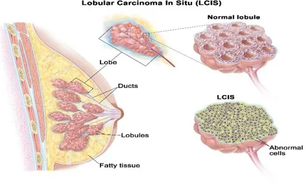 Gambar 2.6: Lobular Carcinoma In Situ (stfranciscare.org) 