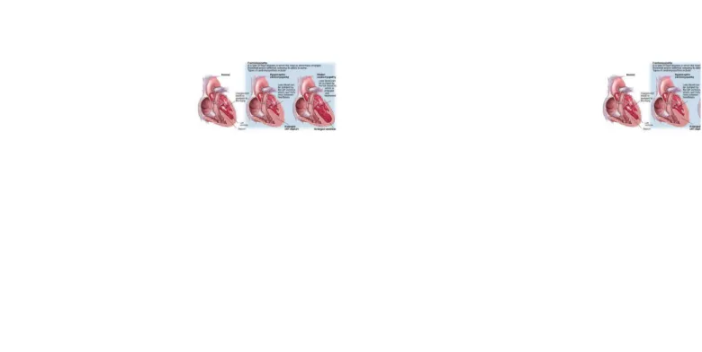 Gambar 8. Perbandingan jantung normal (kiri), kardiomiopati hipertrofik (tengah) danGambar 8