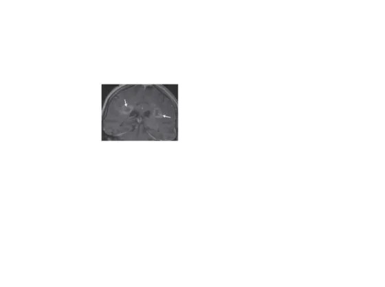 Gambar 6. Potongan koronal pada MRI T1-weighted imaging postkontras. Tanda panah putih menunjukkan lesi “eccentric nodule target sign ”