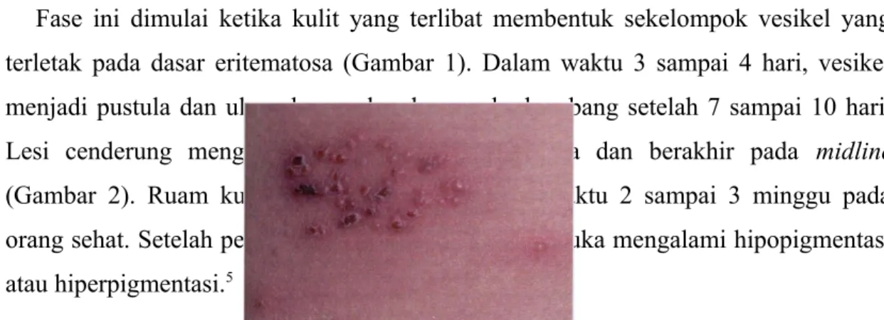 Gambar 1. Herpes zoster. Sekelompok vesikel serta dikelilingi eritema pada kulit