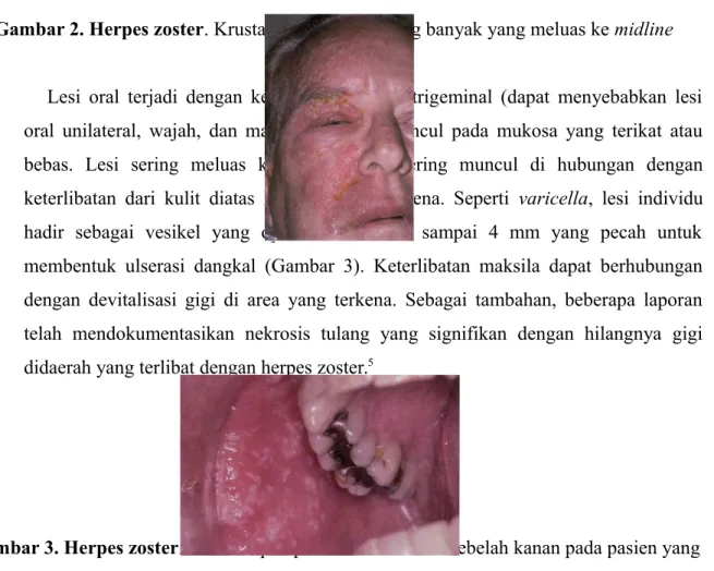 Gambar 2. Herpes zoster. Krusta vesikel wajah yang banyak yang meluas ke midline