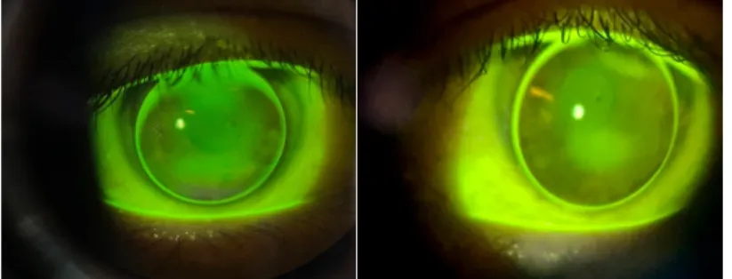 Gambar 3. (A-B) Pemeriksaan fitting RGP dengan fluorescein test     mata kanan dan kiri