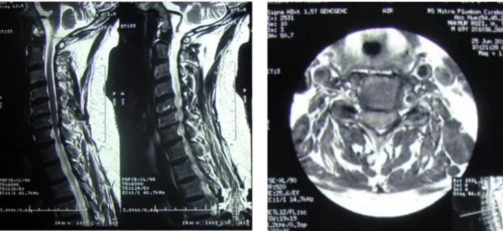 Gambar 1. MRI T2WI sagital dan T1WI aksial kasus 1.  