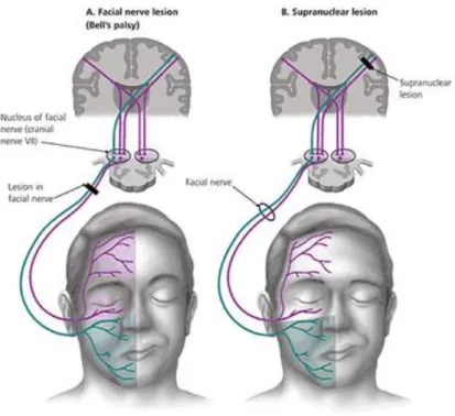 Gambar 12. Perbedaan terjadinya lesi perifer dan sentral nervus fasialis 10 Lesi  pada  nukleus  fasialis  biasanya  terjadi  karena  stroke  atau  tumor