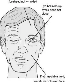 Gambar 13. Bells palsi tidak dapat menutup mata pada sisi yang sakit 10 Pemberian  prednisolon  1mg/kg/  hari  selama  5  hari  menunjukkan  perbaikan  klinis  pada  Bells  palsi