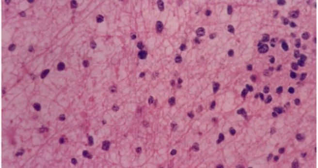 Gambar 5. Astrositoma Fibiler Low-grade  VII. DIAGNOSIS BANDING