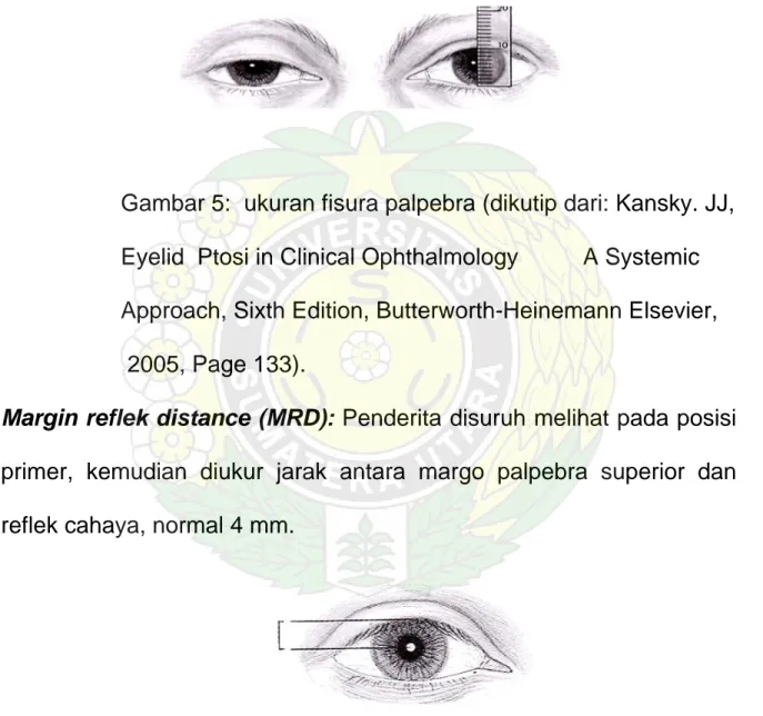 Gambar 5:  ukuran fisura palpebra (dikutip dari: Kansky. JJ,  Eyelid  Ptosi in Clinical Ophthalmology          A Systemic   Approach, Sixth Edition, Butterworth-Heinemann Elsevier,   2005, Page 133)