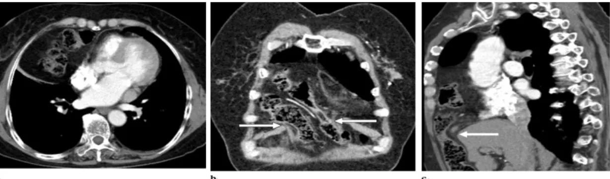 Gambar 15. Morgagni hernia pada wanita usia 70th dengan kelainan pada radiografi dada