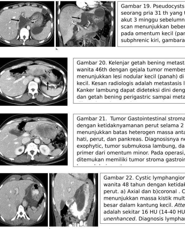 Gambar 19. Pseudocysts pankreas pada  seorang pria 31 th yang telah pankreatitis  akut 3 minggu sebelumnya
