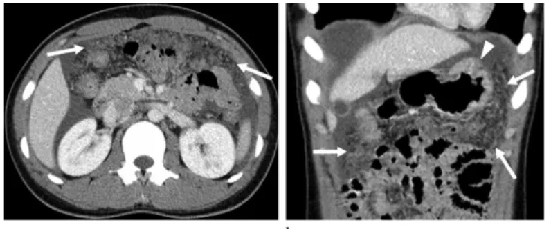 Gambar   2.   Carcinomatosis   peritoneal   pada   seorang   pria   22   tahun   dengan   nyeri   epigastrium
