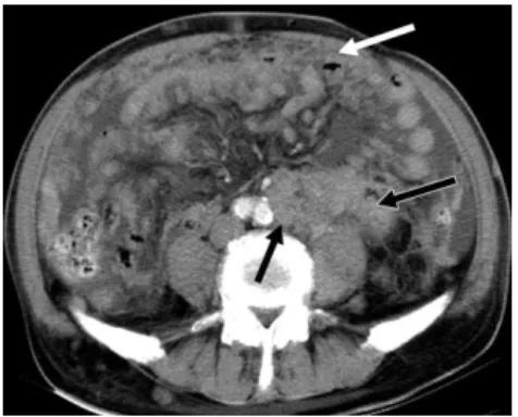 Gambar 7. Lymphomatosis peritoneal pada pasien  pria 71th dengan distensi abdomen selama 15 hari