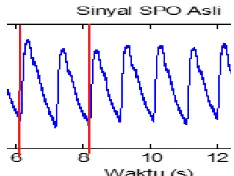 Gambar 9. Sinyal ECG Perempuan dengan Periode 0,95 detik. 