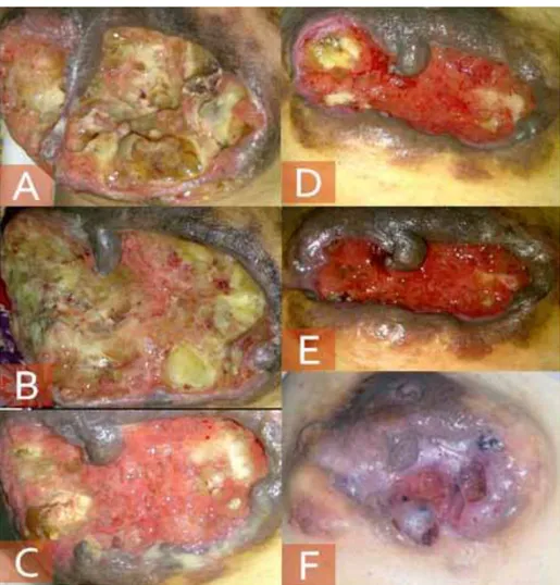Gambar 2. Menunjukkan pros- pros-es makroskopik “pelelehan” sel  kanker dan regenerasi sel normal  selama pengobatan kanker  pay-udara dengan luka yang sudah  terbuka