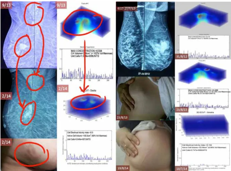 Gambar 3. Mammogram dan foto kanker payudara selama pengobatan dengan  ECCT beserta gambar sifat listrik yang diambil dengan menggunakan ECVT.