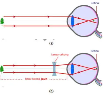 Gambar 2. (a) mata miopi (b) dibantu dengan menggunakan lensa cekung 
