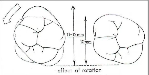 Gambar 5. Gambaran dari oklusal koreksi rotasi molar. Penambahan ruang sekitar 1-2 mm dari panjang lengkung di setiap sisinya dapat mengoreksi rotasi molar.7 