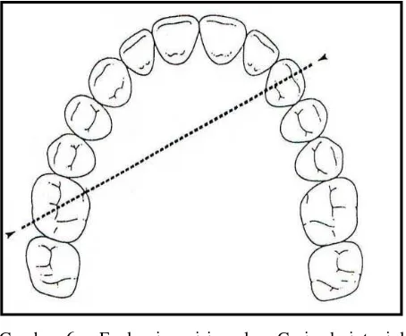 Gambar 6.  Evaluasi posisi molar. Garis dari tonjol mesiolingual dan distobukal dari molar ditarik melintasi gigi kaninus di sebelah sisi.7 