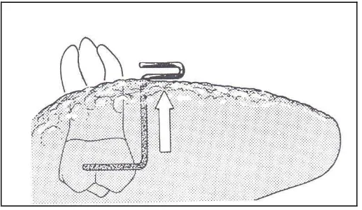 Gambar 8. Efek intrusi dari lengkung transpalatal. Menurut Cetlin, ekstrusi molar dapat dicegah dengan menempatkan omega loop dalam arah mesial