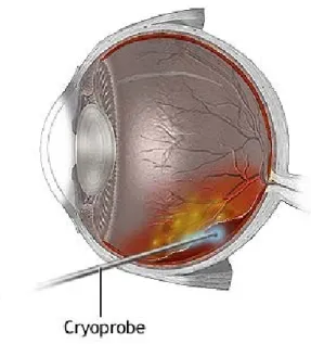 Gambar 7. Penggunaan Cryoprobe pada Ablasio Retina 2
