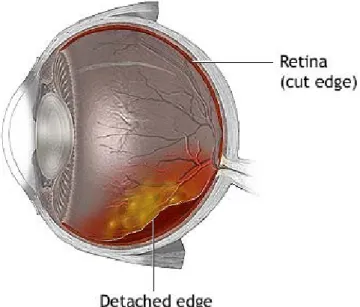 Gambar 1. Ablasio Retina 2