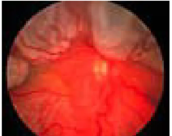 Gambar 2. Ablasio Retina Regmatogenosa 4