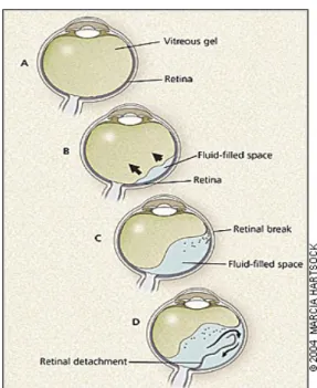 Gambar 5. Patogenesis Ablasio Retina Tipe Regmatogenosa 6