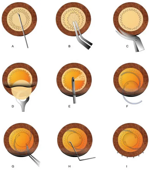 Gambar 6. Langkah bedah ekstraksi katarak ekstrakapsular konvensional dengan  implantasi   IOL   posterior:  Teknik   capsulotomy  anterior,   teknik pembuka kaleng; B, pembersihan kapsul anterior; C, penyelesaian bagian corneo-scleral;  D,  pembersihan   