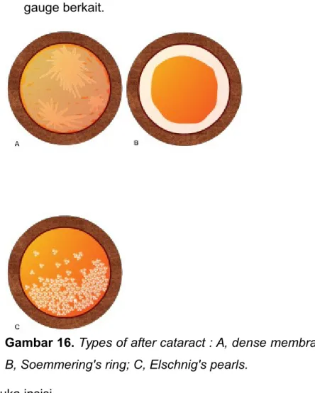 Gambar 16. Types of after cataract : A, dense membranous;