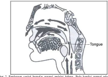 Gambar 3. Pandangan koronal bernafas normal melalui hidung. Pada kondisi normal lidah berada di cekungan palatal