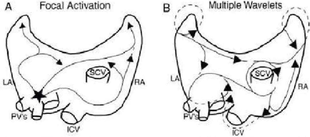 Gambar 3. A. Proses aktivasi fokal atrial fibrilasi dan B. Proses Multiple