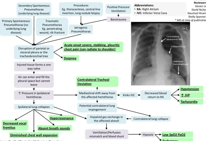 Gambar 4. Mekanisme terjadinya pneumothorax