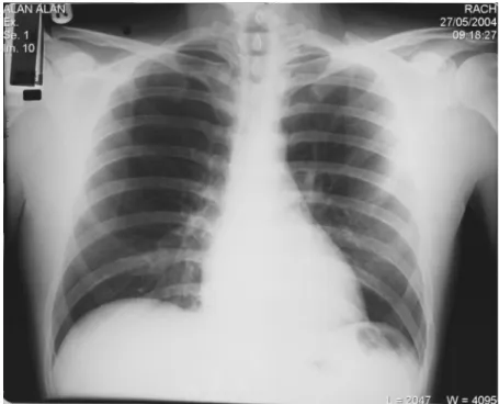 Gambar 5. Tampilan foto polos pasien pneumothorax